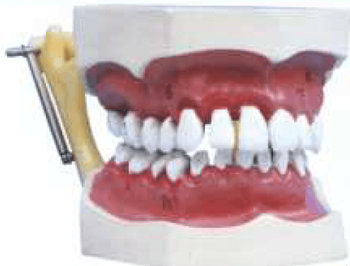 مولاژ تورم لثه