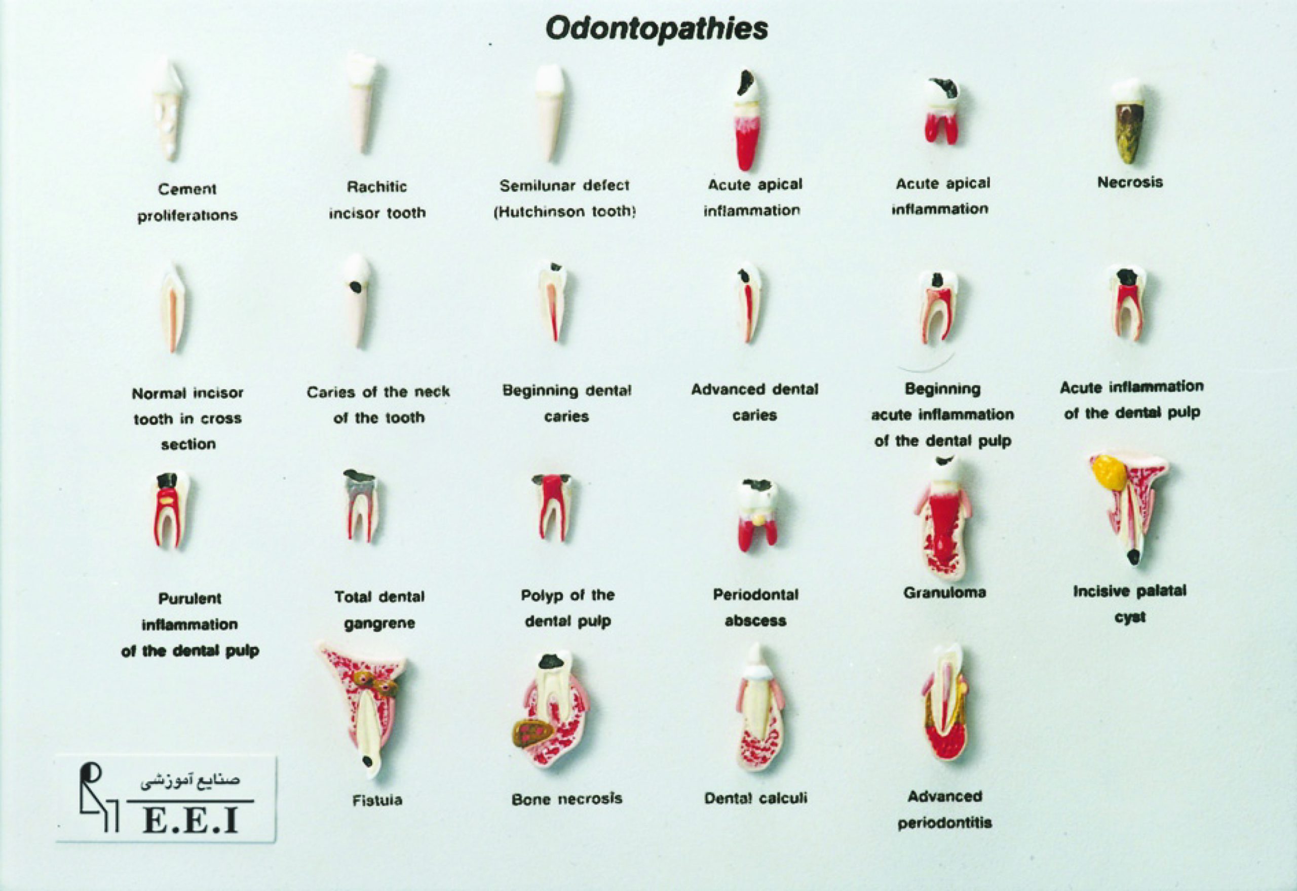 مولاژ مدل بیماری های دندان