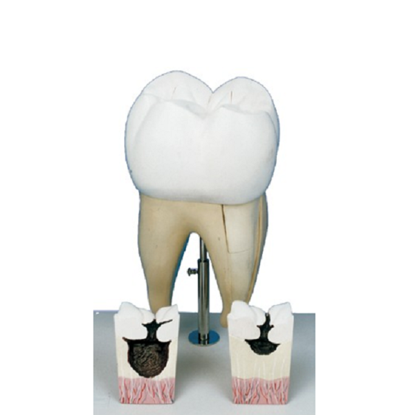 مولاژ اولین دندان آسیای بزرگ فک تحتانی