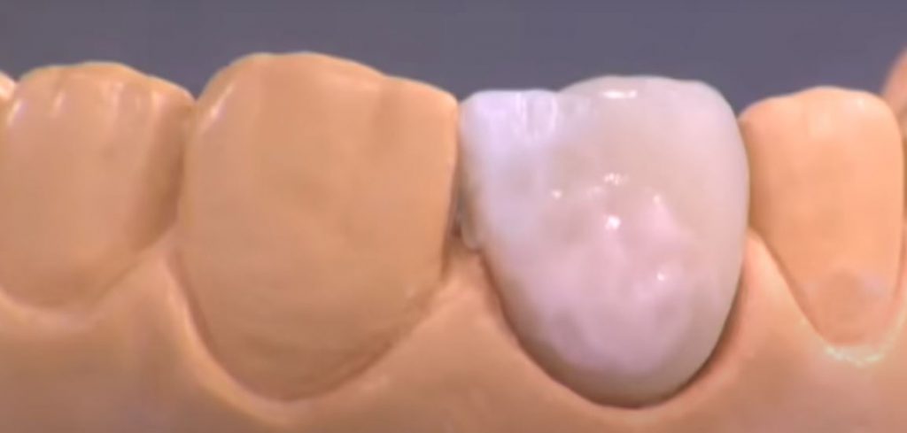 کاربرد کوره در دندانسازی